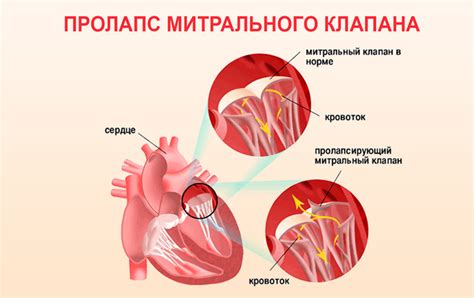 Митральный пролапс: определение и классификация