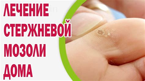 Мозоли на ноге: эффективные методы лечения