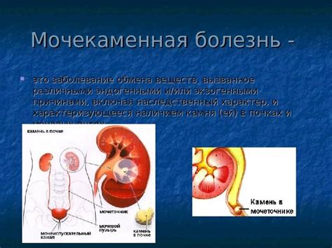 Мочекаменная болезнь и ее проявления: