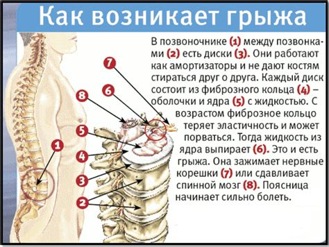 Нарушение структуры хрящей