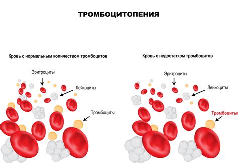 Недостаток тромбоцитов