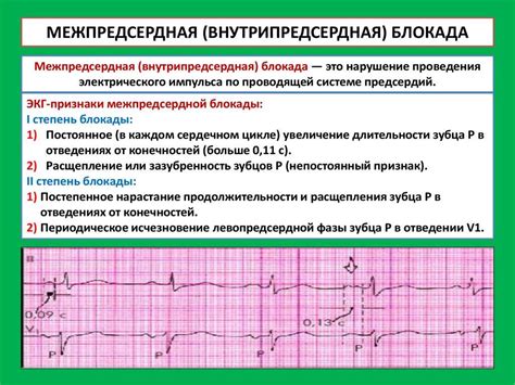 Означение нарушения внутрижелудочковой проводимости по ЭКГ