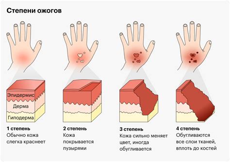 Опасный ожог 2 степени