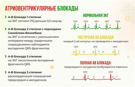 Описание блокады 1й степени на ЭКГ