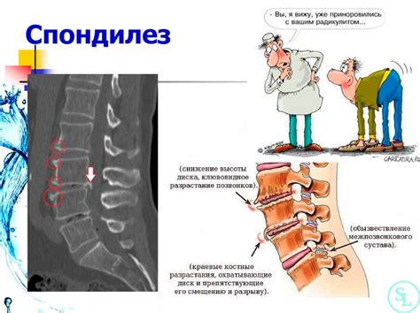 Определение антелистеза позвоночника поясничного отдела