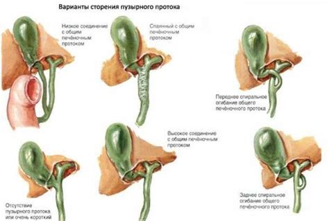 Осложнения деформации желчного пузыря