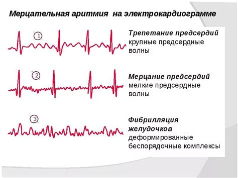 Осложнения эктопического правопредсердного ритма у детей