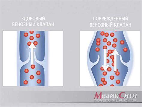 Основные методы лечения дилатации вен малого таза