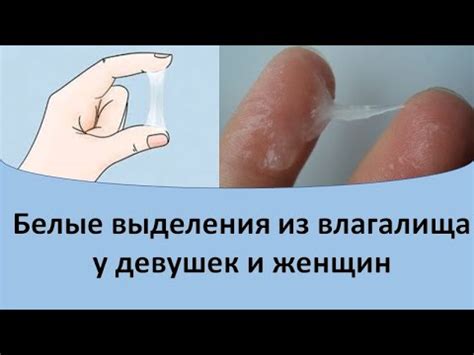 Основные причины белых выделений у девушек