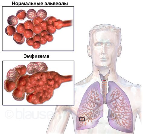 Основные причины дегенеративных изменений глубоких легких