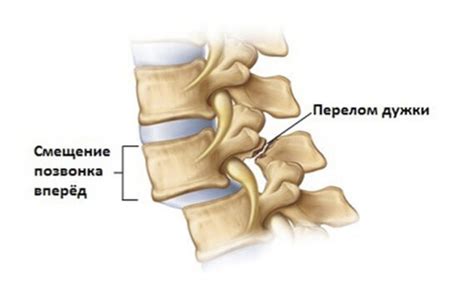 Основные симптомы смещения позвонков