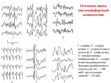 Основные симптомы эпилептиформной активности на ЭЭГ у взрослого