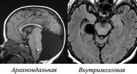 Особенности левой височной доли: