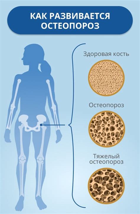 Остеопороз и связанные заболевания