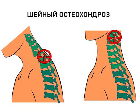 Остеохондроз шейного отдела позвоночника и его влияние на состояние рук