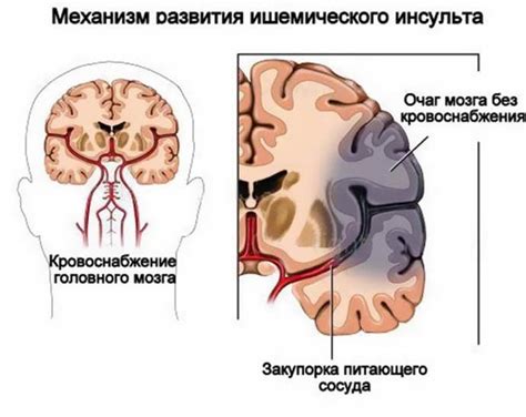 Острая гипоксия мозга