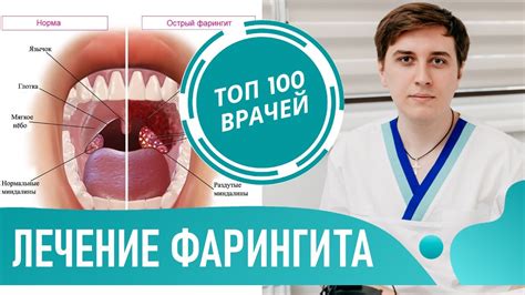 Острый и соленый - раздражение горла