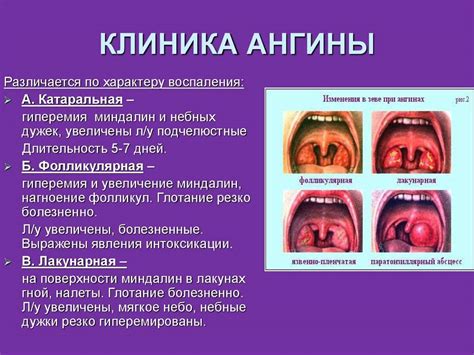 Острый тонзиллит и его симптомы