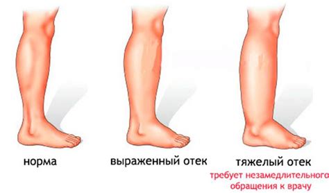 Отечность и отеки ног: как их различить?