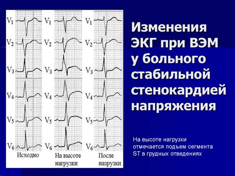 Отличия между стабильной стенокардией и стенокардией напряжения