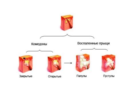 Папулы и пустулы: формы фактом