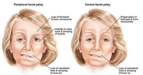 Парез лицевого нерва - причины и симптомы