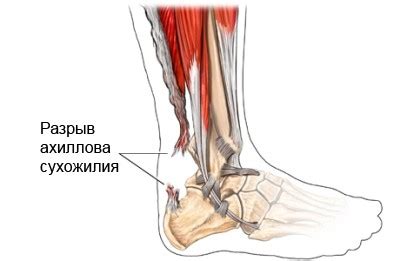 Первая помощь при травме сухожилия под коленом