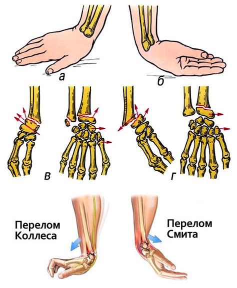 Перелом руки на улице: первая помощь