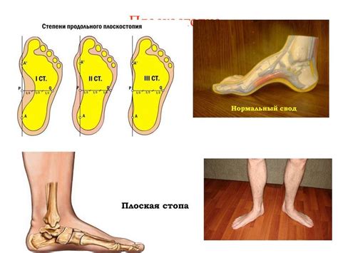 Плоскостопие и ослабленные мышцы