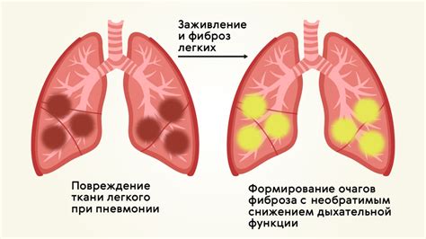 Пневмония и воспаление легких: основные отличия