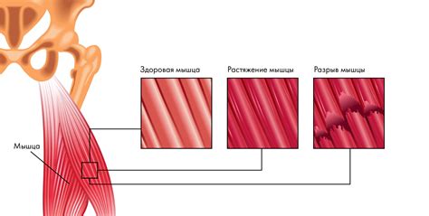 Повреждения мышц