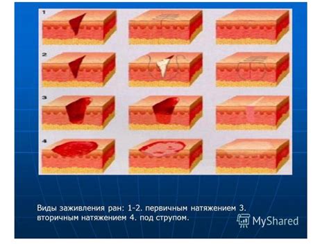 Повторное образование раны