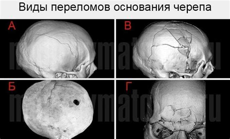 Повышенный риск переломов черепа