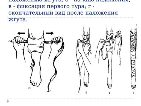 Подготовка к наколке жгута зимой