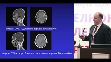 Поддерживающая терапия при метастазах рака головного мозга