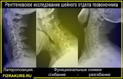 Показания для проведения рентгенографии шейного отдела позвоночника