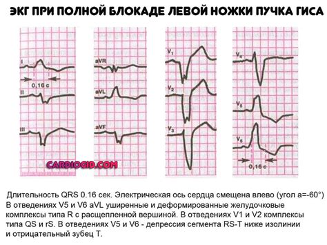 Полная блокада левой ножки пучка Гиса: причины и симптомы