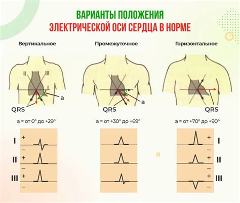 Положение ЭОС и изменение синусового ритма