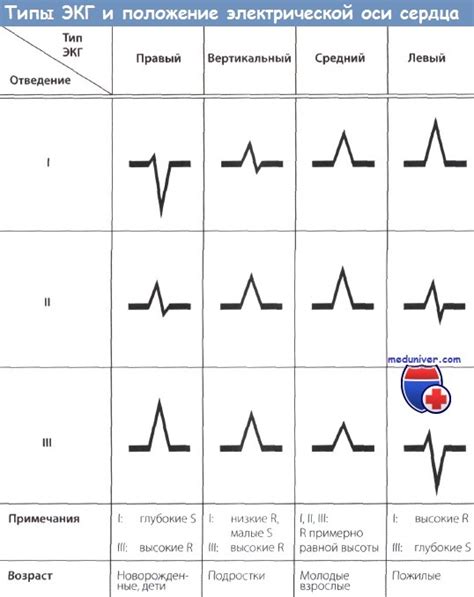 Положение эос на ЭКГ