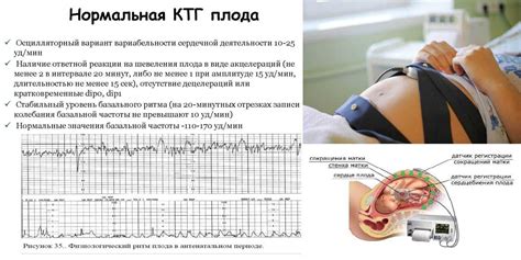 Положительный результат теста КТГ и его значение для оценки плода