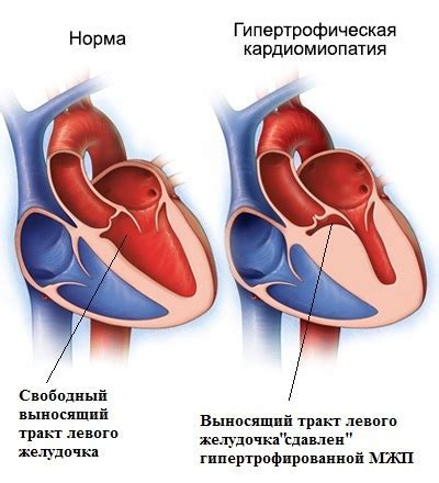 Понятие и причины гипертрофии левого желудочка