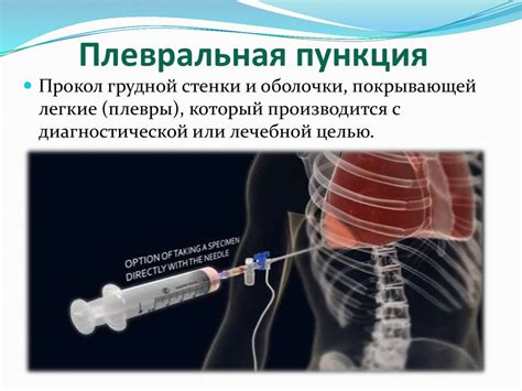 Понятие свободной жидкости в плевральной полости