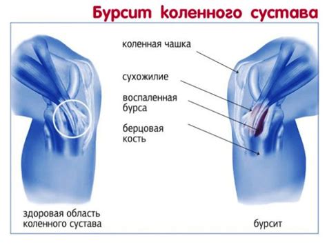 Поражение суставов и суставной сумки