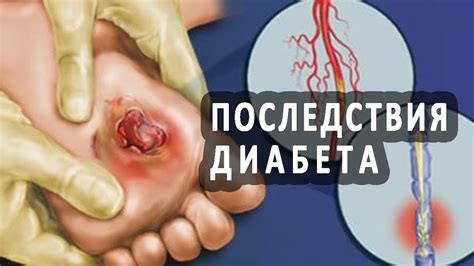 Последствия микроальбуминурии при сахарном диабете