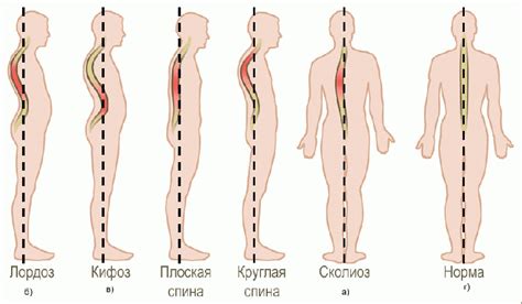 Последствия нарушения осанки