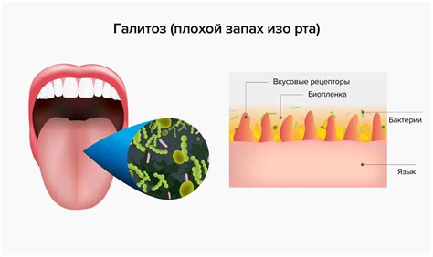 Почему возникает запах ацетона изо рта?