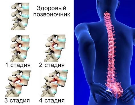 Почему возникает смещение позвонков?