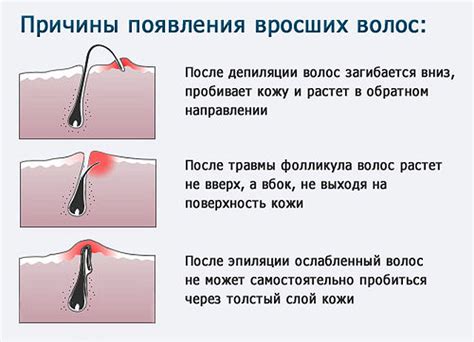 Почему волоски врастают после шугаринга?