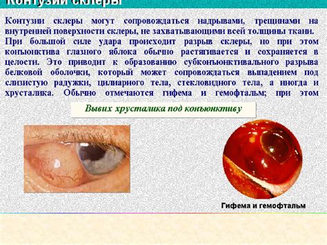 Предотвращение бликов и снижение риска повреждения глаз