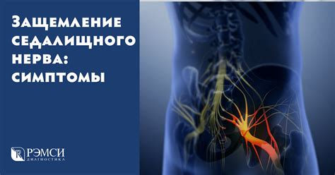 Предупреждение повторного защемления седалищного нерва